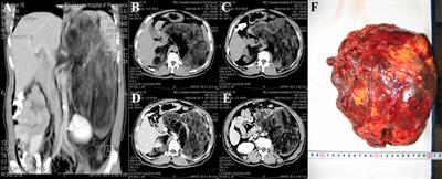 Bilateral adrenal giant medullary lipoma combined with disorders of sex development: a rare case report and literature review